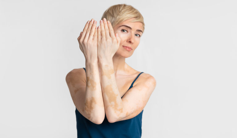 Internal and external causes of vitiligo