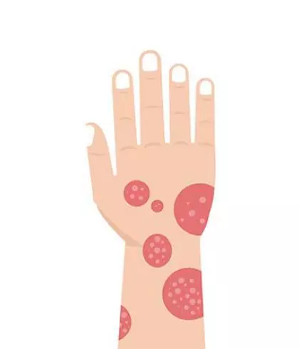 Psoriasis Or Eczema