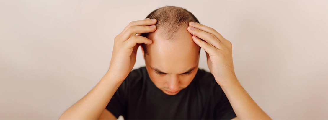 Is Male Pattern Baldness Stoppable?