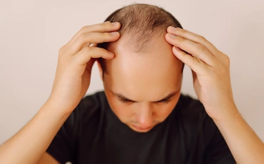 Is Male Pattern Baldness Stoppable?