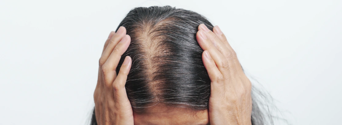 What Are the Best Treatments for Female Hair Thinning?