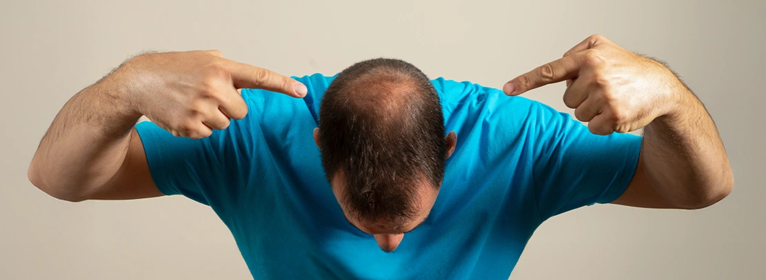 Alopecia