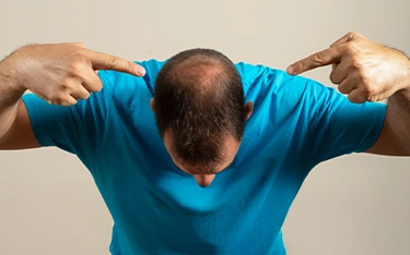 Alopecia