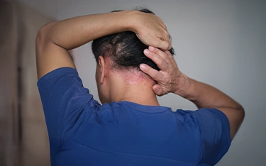 Scalp psoriasis