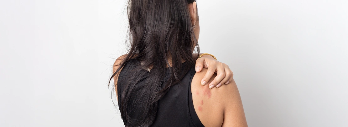 skin allergy