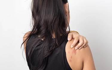 skin allergy
