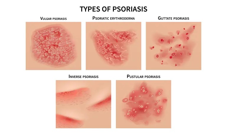 Psoriasis Causes & Treatment: Frequently Asked Questions (FAQ)