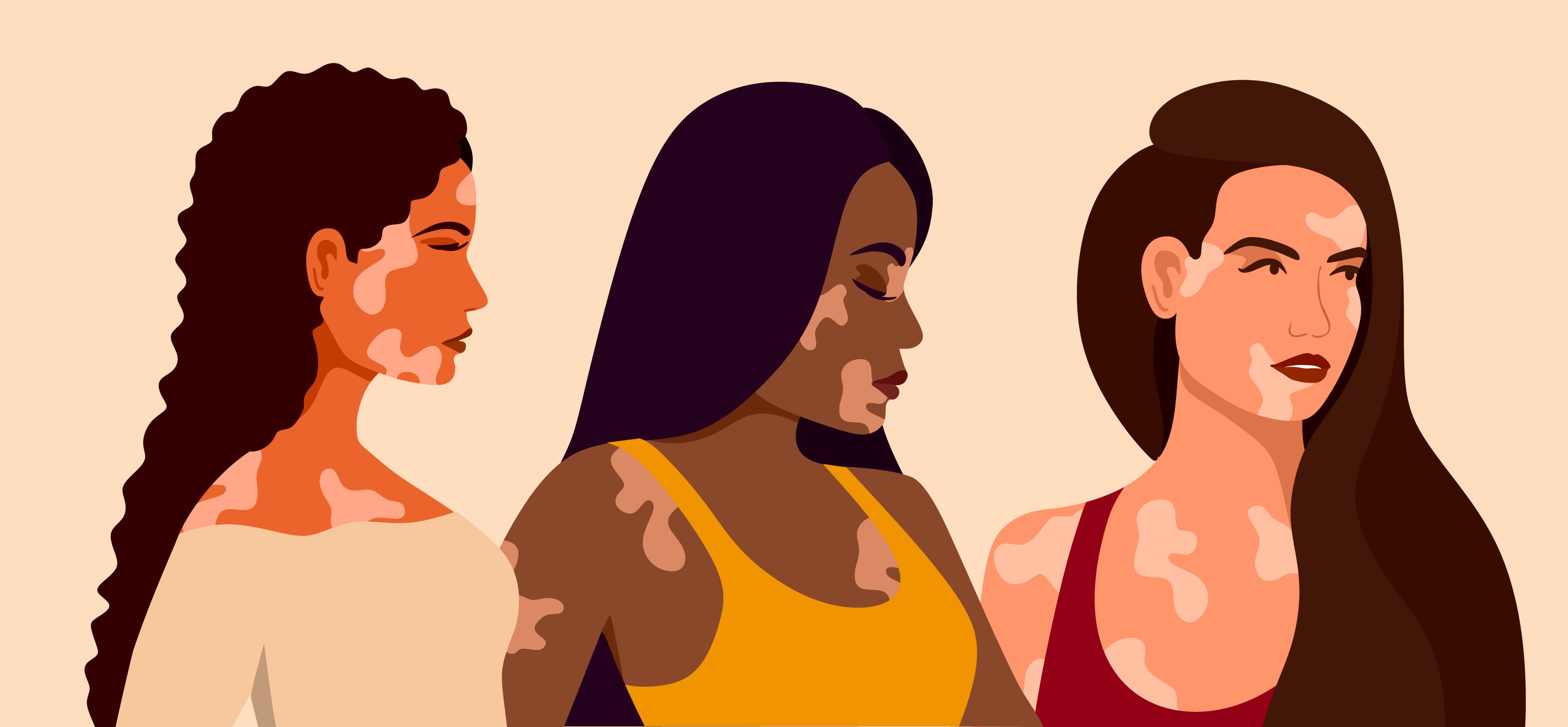 Vitiligo-three-young-women-of-different-races-with-skin-problems