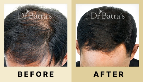 Hair Fall Treatment in Dubai at Dr Batra's® - Before & After 01