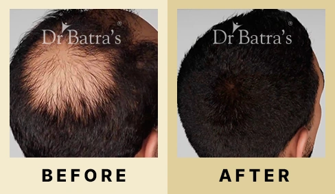 Hair Fall Treatment in Dubai at Dr Batra's® - Before & After 02