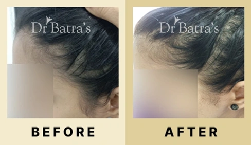 Hair Fall Treatment in Dubai at Dr Batra's® - Before & After 03