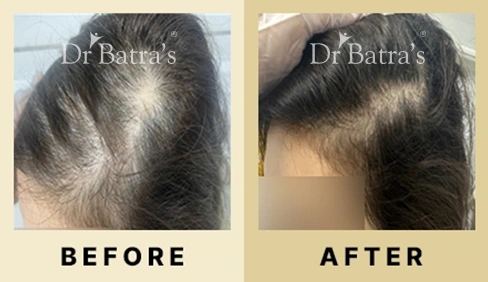 Hair Fall Treatment in Dubai at Dr Batra's® - Before & After 04