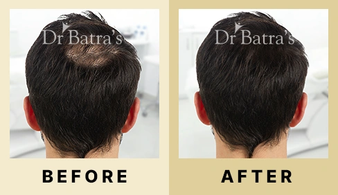 Hair Fall Treatment in Dubai at Dr Batra's® - Before & After 05
