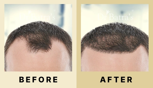 Hair Fall Treatment in Dubai at Dr Batra's® - Before & After 06