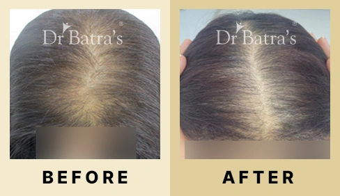 Hair Fall Treatment in Dubai at Dr Batra's® - Before & After 07