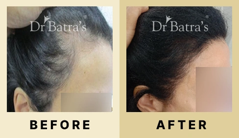 Hair Fall Treatment in Dubai at Dr Batra's® - Before & After 08
