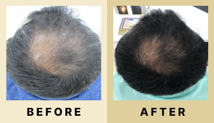 Hair Fall Treatment in Dubai at Dr Batra's® - Before & After 09