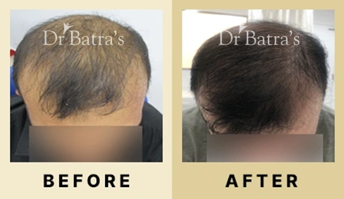 Hair Fall Treatment in Dubai at Dr Batra's® - Before & After 10