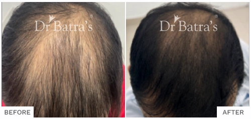 Hair Loss