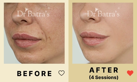 03 Before After