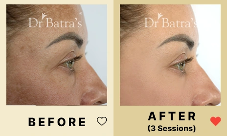 04 Before After
